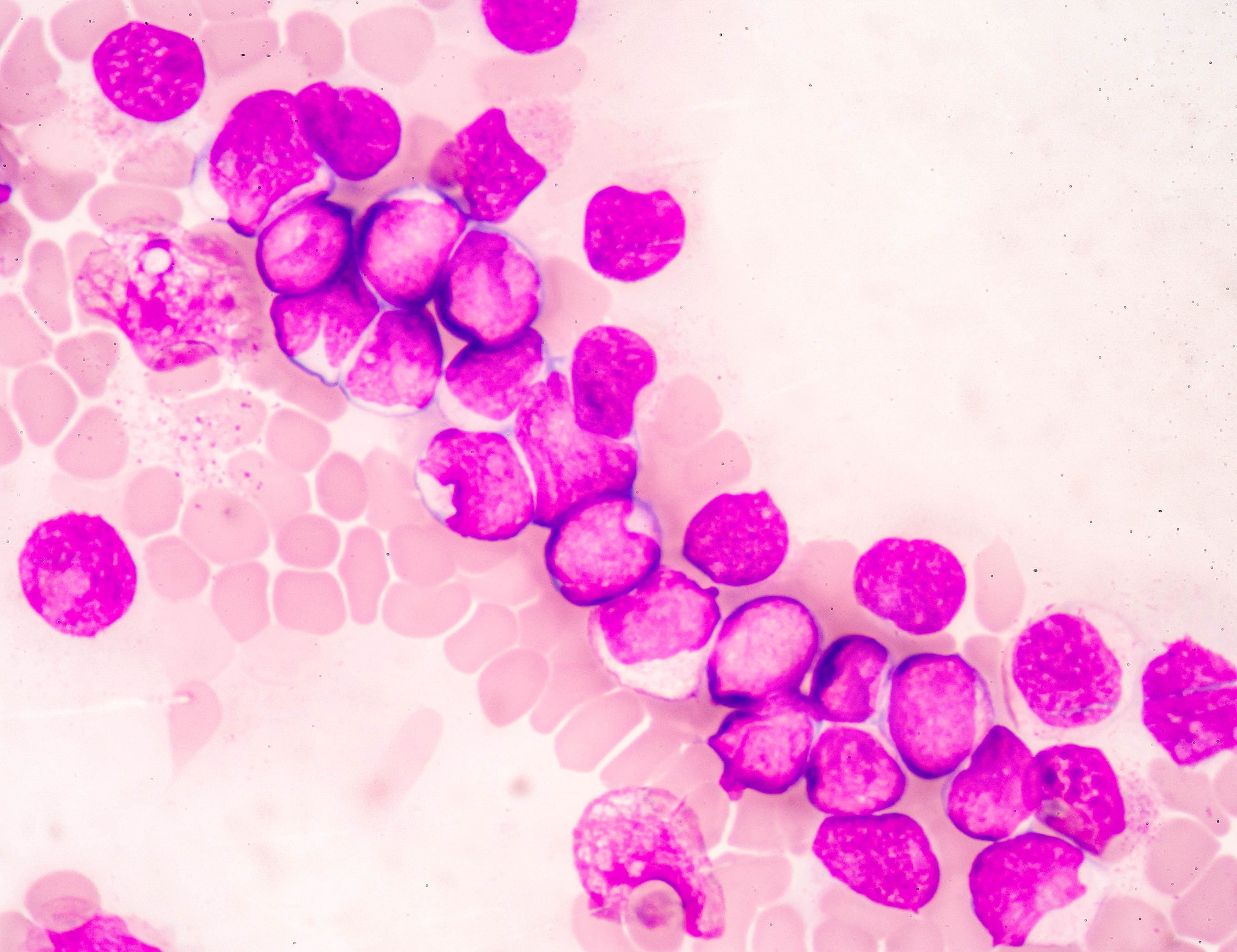 Leucemia Mieloide Cronica