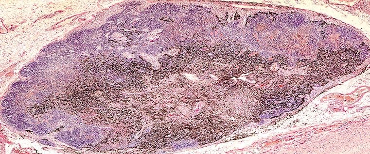 Linfoma di Hodgkin